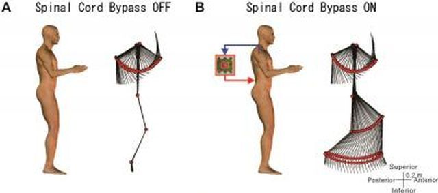 spinal-cord-bypass