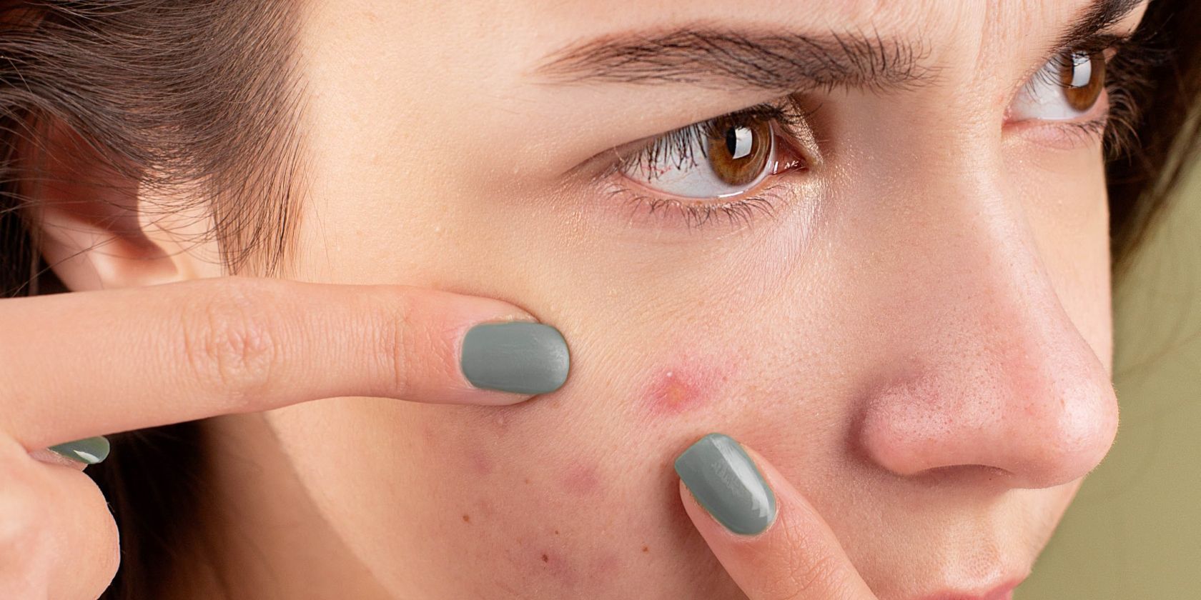 Struggling With Acne? You Need to Use These 6 Apps