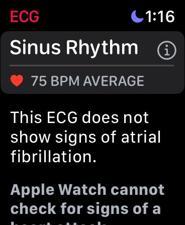 Hasil EKG di Apple Watch