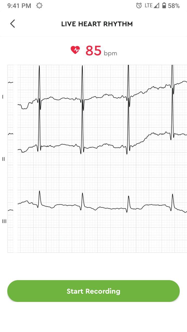 Real time ECG in bioheart